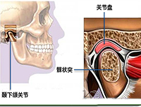 顳下頜關節紊亂病